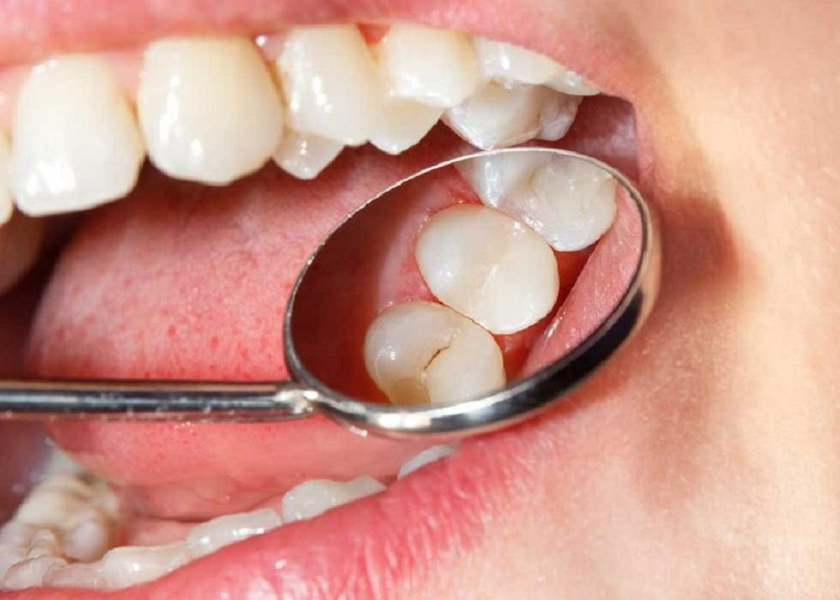 Việc bạn đang trải qua các vấn đề về sức khỏe và vệ sinh miệng cũng có thể nằm mơ thấy hàm răng mình bị rụng
