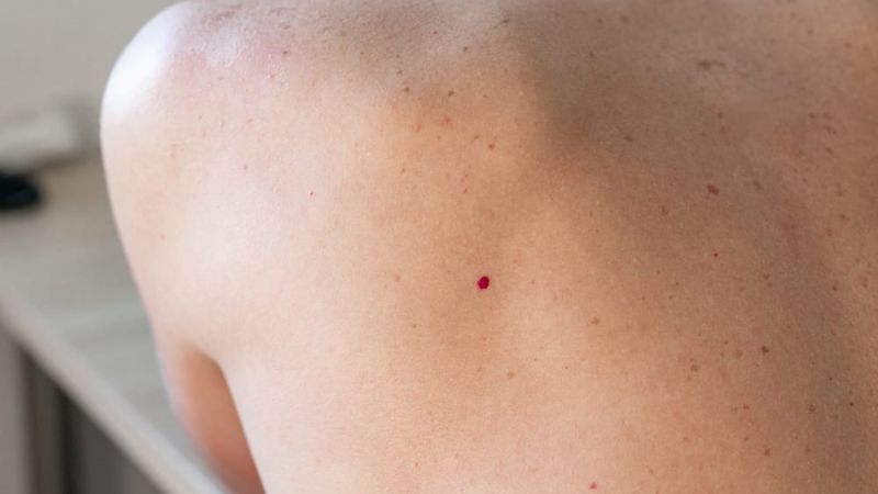 Nốt ruồi son xuất hiện trên da là hiện tượng bình thường, không gây ảnh hưởng sức khoẻ