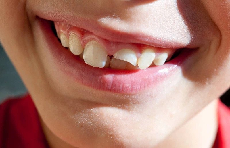Răng mẻ ảnh hưởng sức khỏe răng miệng, vậy bị mẻ răng có điềm gì trong nhân tướng học không? 