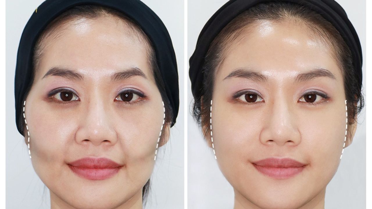 Phụ nữ sở hữu gò má cao có thể phẫu thuật thẩm mỹ, tiêm botox hay makeup để cải thiện gương mặt 