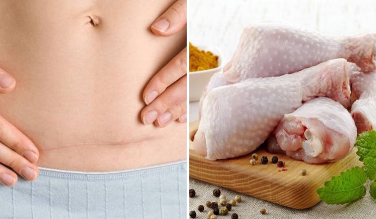 sinh mổ bao lâu thì được ăn thịt gà? Khoảng 2 tháng 