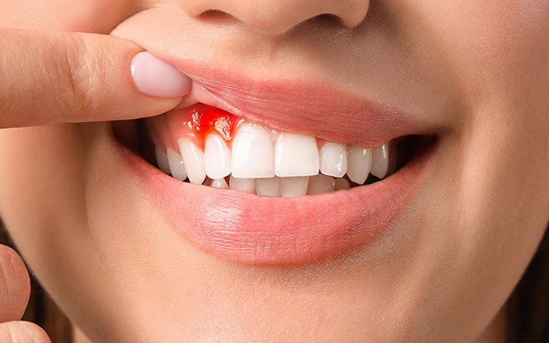 Nằm mơ thấy hàm răng bị chảy máu là điềm báo rất xấu liên quan đến sức khỏe