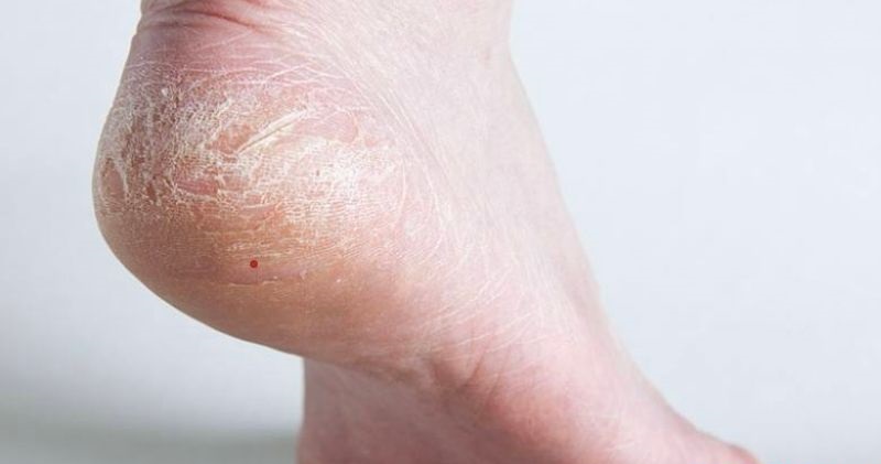 Nốt ruồi son ở gót chân thường mang đến may mắn và tiền tài cho người sở hữu
