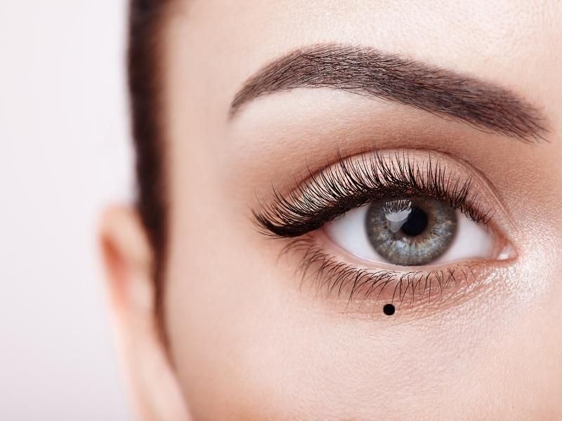 Nốt ruồi ở mi mắt là những khối u lành tính xuất hiện xung quanh viền mắt