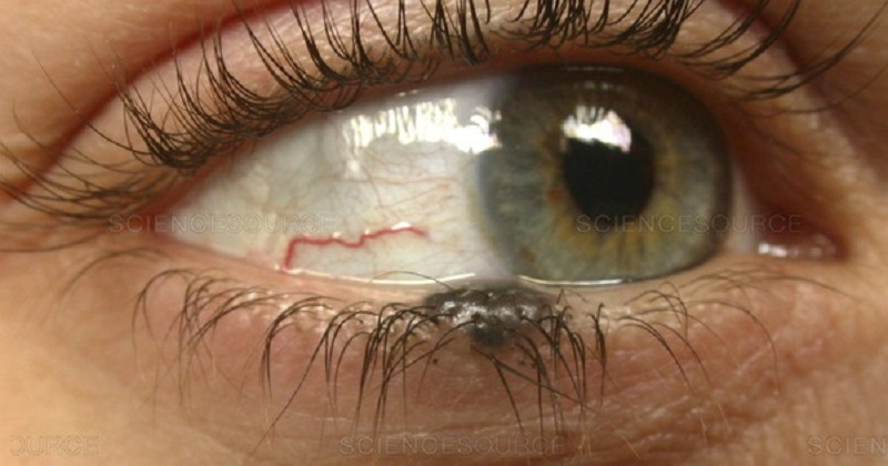 Nốt ruồi ở mi mắt có thể là khối u ác tính, ảnh hưởng nghiêm trọng đến sức khoẻ