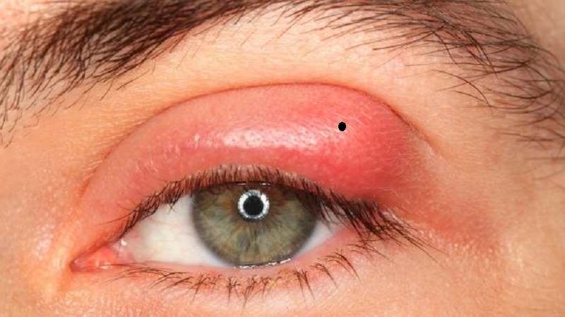 Nếu nốt ruồi nằm ở mi mắt bị sưng tấy, ngứa rát thì nên đi thăm khám bác sĩ