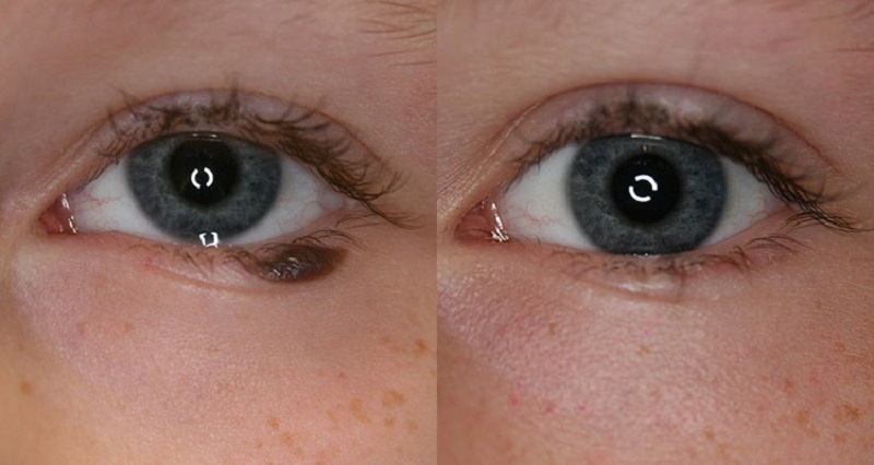 Tẩy nốt ruồi ở mi mắt có ảnh hưởng đến phong thuỷ vận mệnh cuộc đời không?